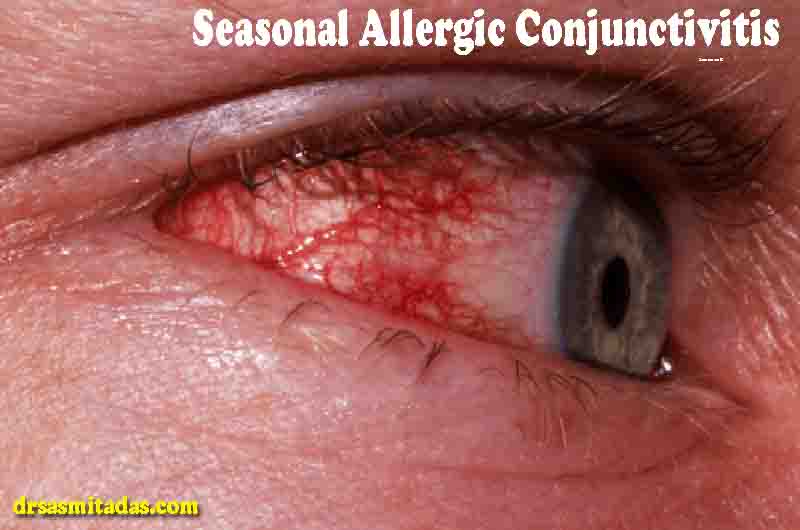 Seasonal Allergic Conjunctivitis (Eye Allergy): Patient Education Handout